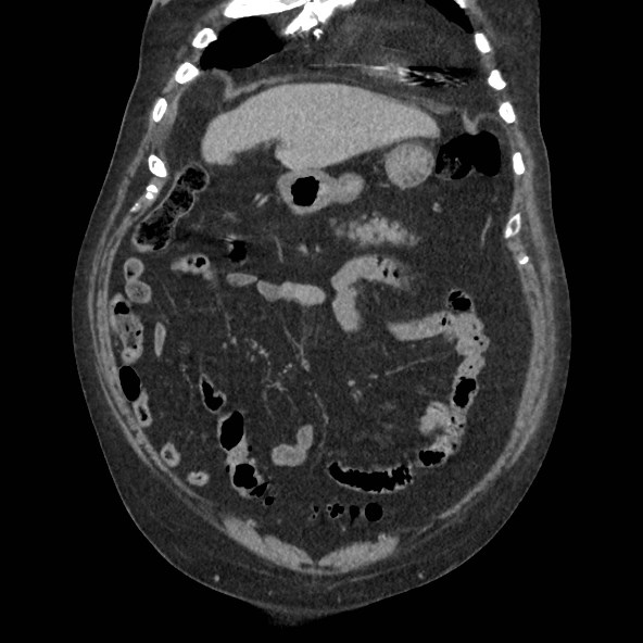 Adrenal lymphoma (Radiopaedia 84145-99415 Coronal C+ portal venous phase 19).jpg
