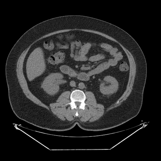 Adrenal myelolipoma (Radiopaedia 26278-26407 Axial non-contrast 32).jpg