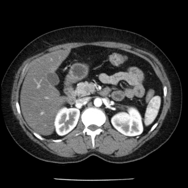 Adrenal myelolipoma (Radiopaedia 43401-46759 Axial C+ arterial phase 37).jpg