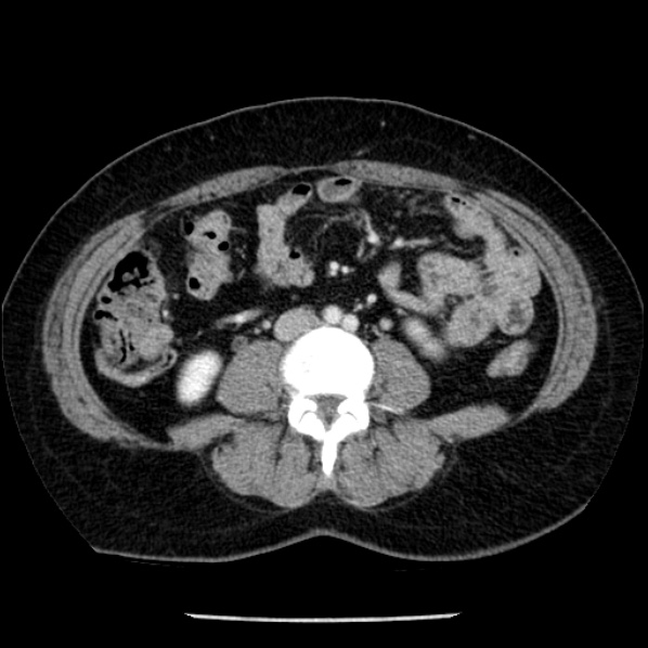 Adrenal myelolipoma (Radiopaedia 43401-46759 Axial C+ portal venous phase 49).jpg
