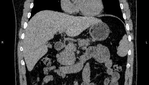 Adrenal myelolipoma (Radiopaedia 84321-99619 Coronal non-contrast 33).jpg
