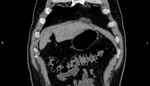 Adrenal myelolipoma (Radiopaedia 84321-99619 Coronal non-contrast 8).jpg