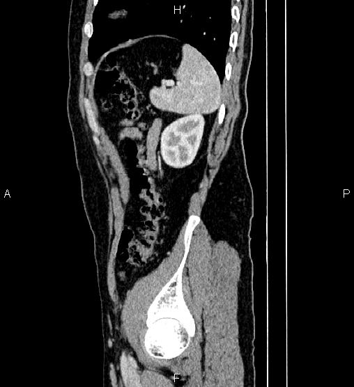 Adrenal myelolipoma (Radiopaedia 87794-104246 Sagittal renal cortical phase 78).jpg