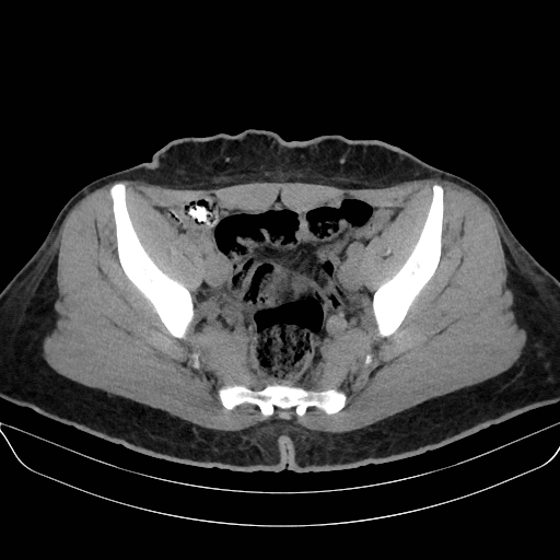 Adrenal myelolipoma - bilateral (Radiopaedia 74805-85810 Axial non-contrast 69).jpg
