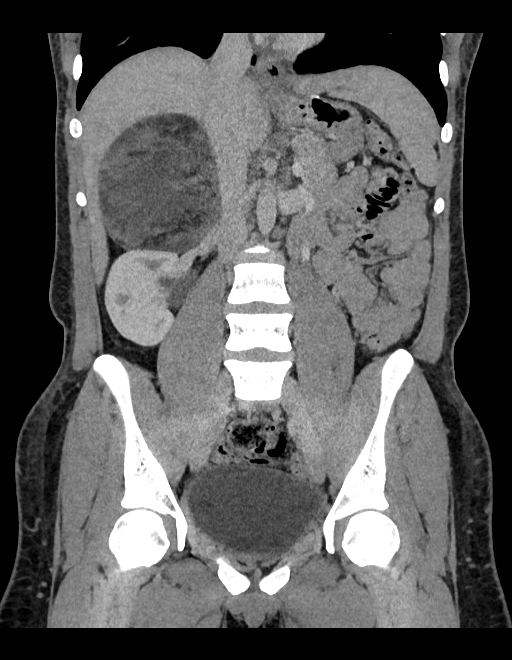 Adrenal myelolipoma - bilateral (Radiopaedia 74805-85810 Coronal C+ portal venous phase 150).jpg