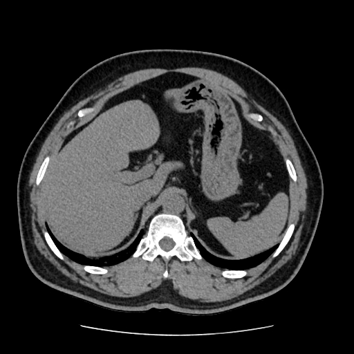 Adrenal myelolipoma and beaver tail liver (Radiopaedia 86201-102193 Axial non-contrast 112).jpg