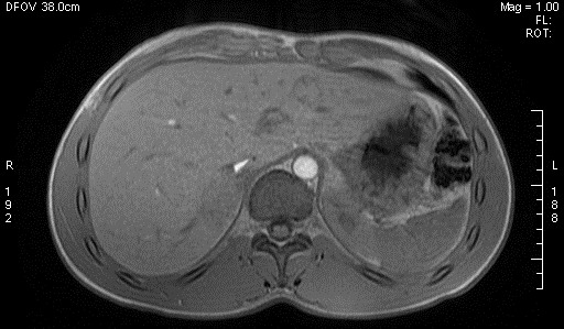 File:Adrenal pheochromocytoma (Radiopaedia 35133-36730 Axial T1 out-of-phase 1).jpg
