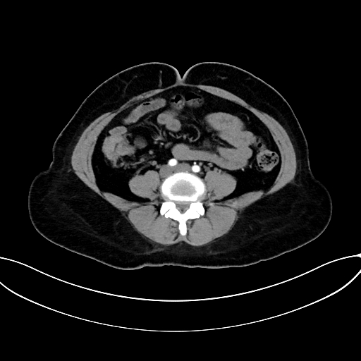 Adrenocortical carcinoma (Radiopaedia 87281-103569 Axial C+ arterial phase 56).jpg