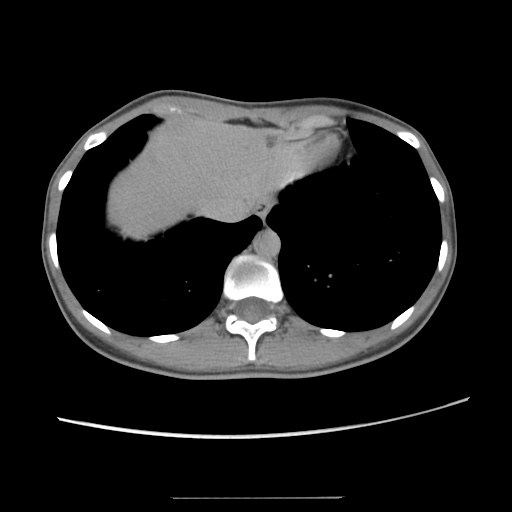 Adult polycystic kidney disease (Radiopaedia 48845-53876 Axial renal excretory phase 17).jpg