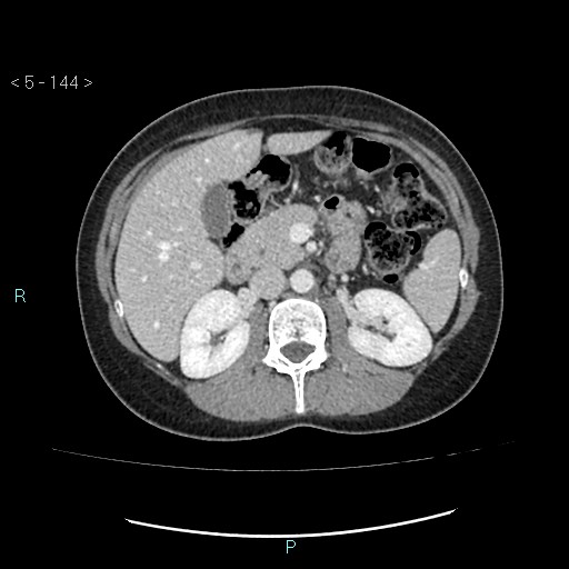 Adult transient intestinal intussusception (Radiopaedia 34853-36310 Axial C+ portal venous phase 17).jpg