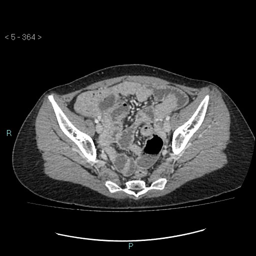 Adult transient intestinal intussusception (Radiopaedia 34853-36310 Axial C+ portal venous phase 92).jpg