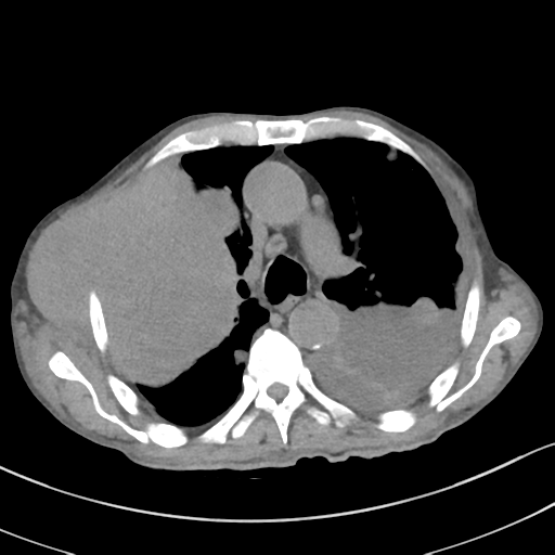 Advanced metastatic lung cancer (Radiopaedia 48910-53954 Axial non-contrast 26).png