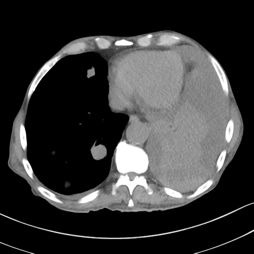 Advanced metastatic lung cancer (Radiopaedia 48910-53954 Axial non-contrast 46).png