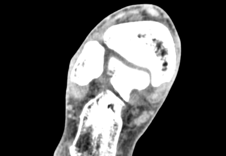 File:Advanced osteomyelitis due to open metatarsal fracture (Radiopaedia 83891-99095 Axial non-contrast 3).jpg