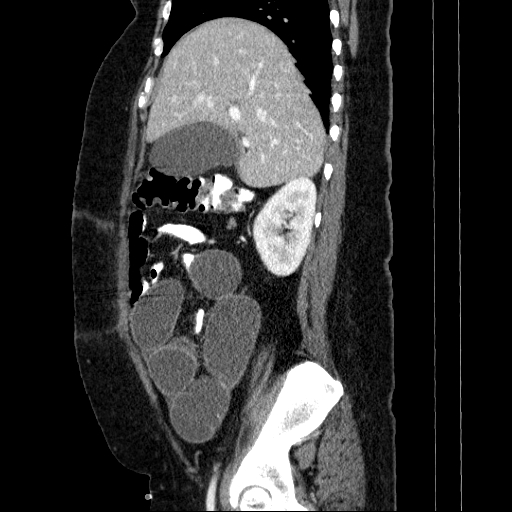 File:Afferent loop syndrome - secondary to incarcerated trocar site hernia (Radiopaedia 82959-97305 Sagittal C+ portal venous phase 110).jpg