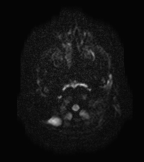 File:Aicardi syndrome (Radiopaedia 66029-75205 Axial DWI 1).jpg