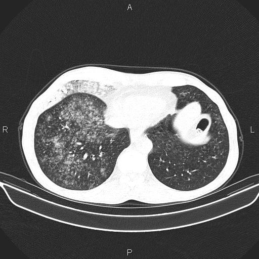 File:Air bronchogram in pneumonia (Radiopaedia 85719-101512 Axial lung window 53).jpg