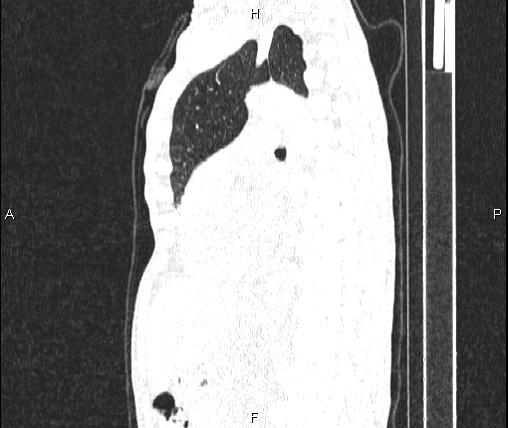 Air bronchogram in pneumonia (Radiopaedia 85719-101512 Sagittal lung window 57).jpg