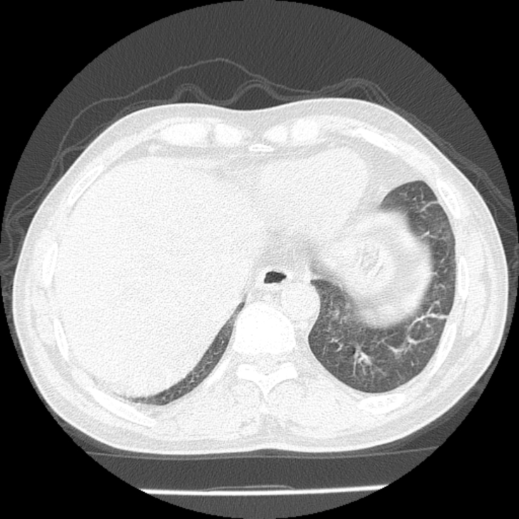 Airway foreign body in adult (Radiopaedia 85907-101779 Axial lung window 158).jpg