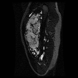 Alveolar soft part sarcoma (Radiopaedia 64501-73678 D 98).jpg