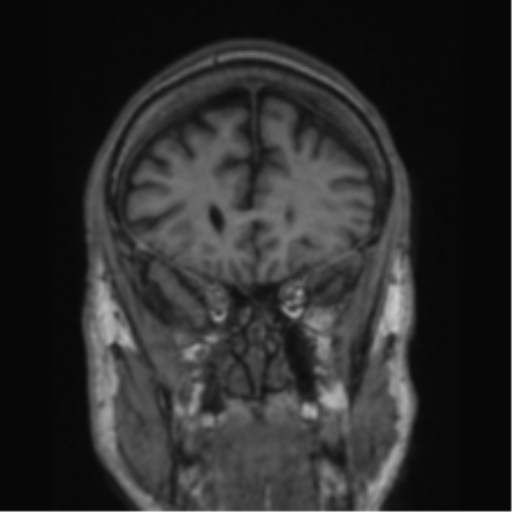 File:Alzheimer's disease- with apraxia (Radiopaedia 54763-61011 Coronal T1 69).png