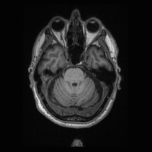 Alzheimer disease - probable (Radiopaedia 35334-36837 Axial T1 26).png