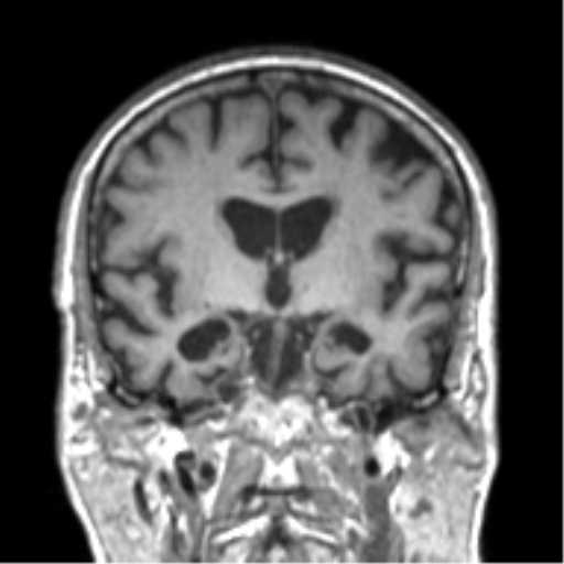 Alzheimer disease and cerebral amyloid angiopathy (Radiopaedia 64234-73011 Coronal T1 35).png