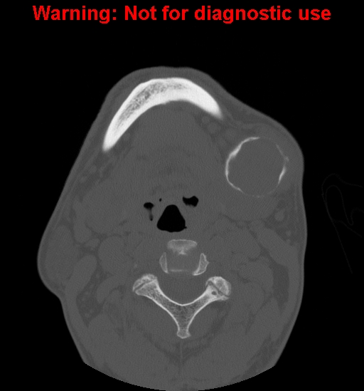 File:Ameloblastoma (Radiopaedia 13276-13280 Axial non-contrast 6).jpg
