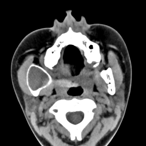 File:Ameloblastoma (Radiopaedia 26645-26793 Axial C+ delayed 24).jpg