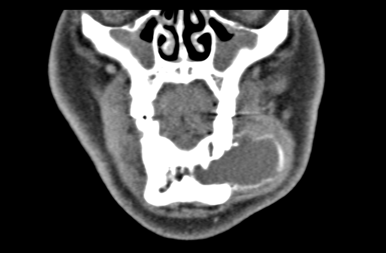 File:Ameloblastoma (Radiopaedia 33677-34806 Coronal non-contrast 18).png
