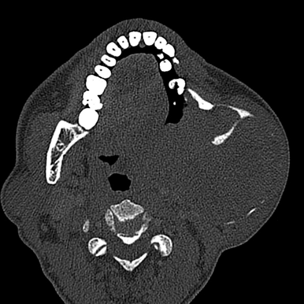 Ameloblastoma (Radiopaedia 51921-57766 Axial bone window 79).jpg