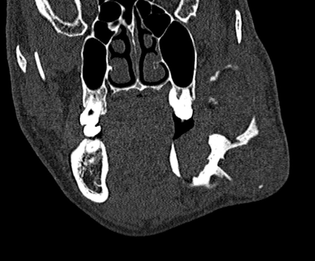 Ameloblastoma (Radiopaedia 51921-57766 Coronal bone window 98).jpg