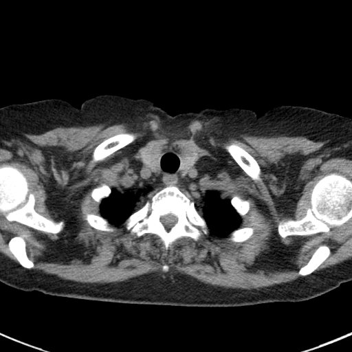 Amiodarone-induced pulmonary fibrosis (Radiopaedia 82355-96460 Axial non-contrast 8).jpg