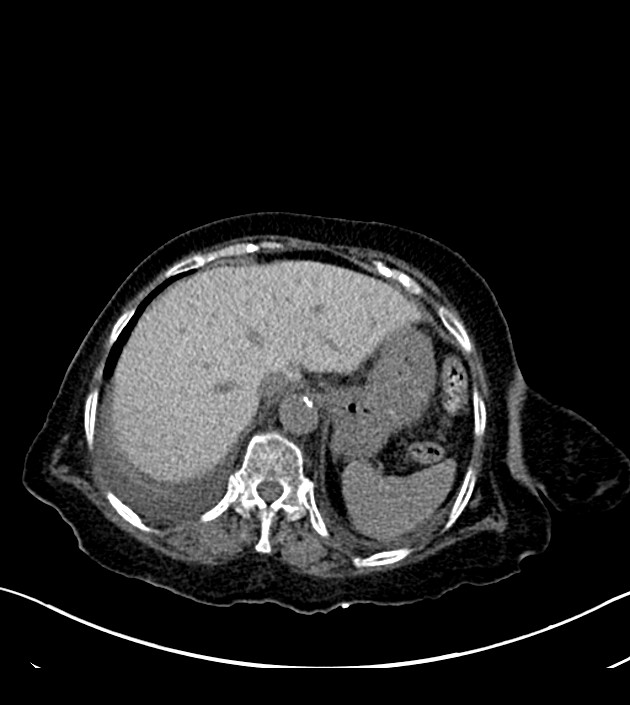 Amiodarone deposition in the liver (Radiopaedia 77587-89780 Axial non-contrast 74).jpg