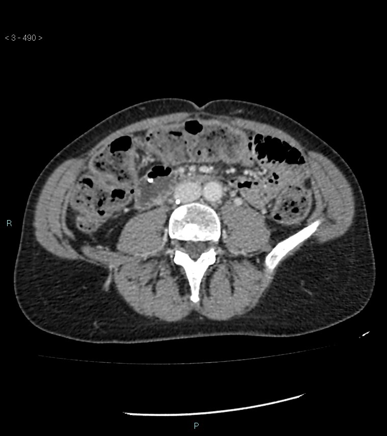 Ampulla of Vater metastasis (Radiopaedia 27820-28069 A 128).jpg