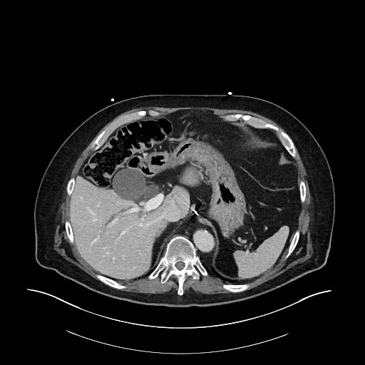 Ampullary adenocarcinoma (Radiopaedia 59373-66734 C 39).jpg
