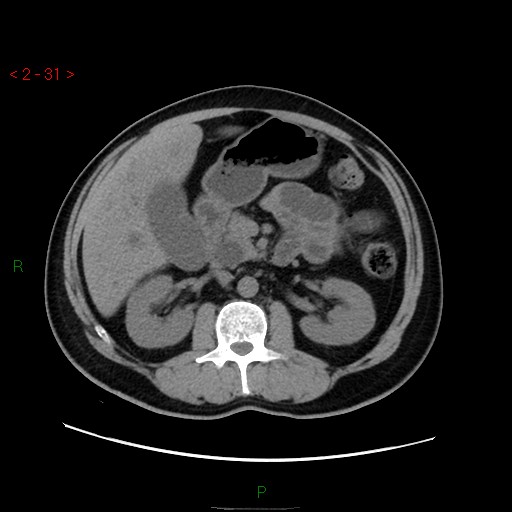 File:Ampullary carcinoma (Radiopaedia 56396-63056 Axial non-contrast 21).jpg