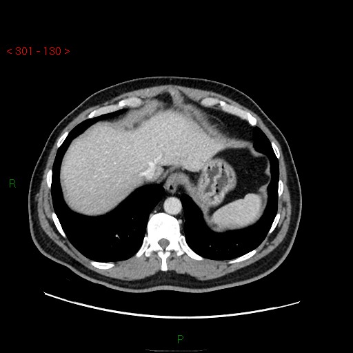 Ampullary carcinoma (Radiopaedia 56396-63056 C 14).jpg