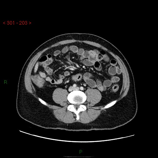 Ampullary carcinoma (Radiopaedia 56396-63056 C 63).jpg