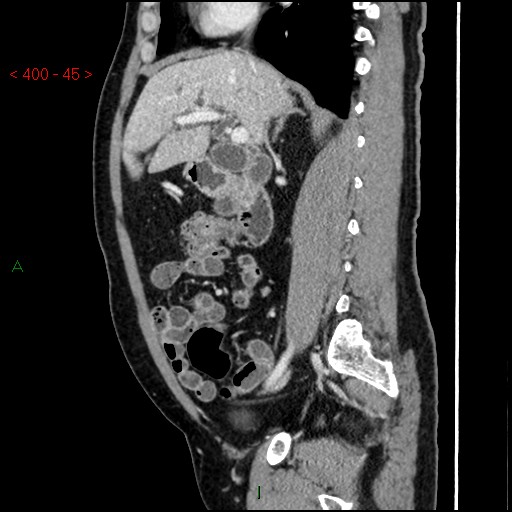 Ampullary carcinoma (Radiopaedia 56396-63056 D 44).jpg