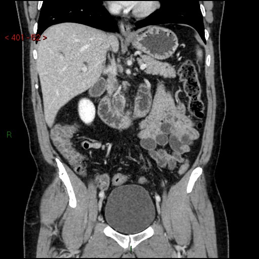 Ampullary carcinoma (Radiopaedia 56396-63056 E 51).jpg