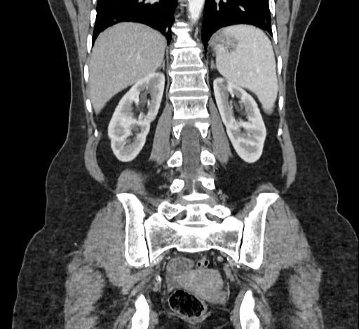 Ampullary tumor (Radiopaedia 60333-67998 B 56).jpg