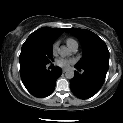 File:Amyloidosis - bronchial and diffuse nodular pulmonary involvement (Radiopaedia 60156-67744 Axial non-contrast 31).jpg