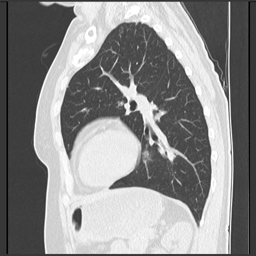 Amyloidosis - bronchial and diffuse nodular pulmonary involvement (Radiopaedia 60156-67744 F 38).jpg