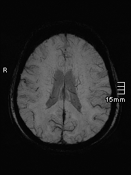 File:Amyotrophic lateral sclerosis (Radiopaedia 70821-81017 Axial SWI minIP 31).jpg