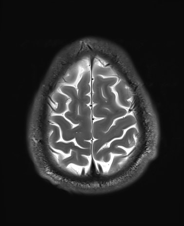 File:Amyotrophic lateral sclerosis (Radiopaedia 87352-103658 Axial T2 26).jpg