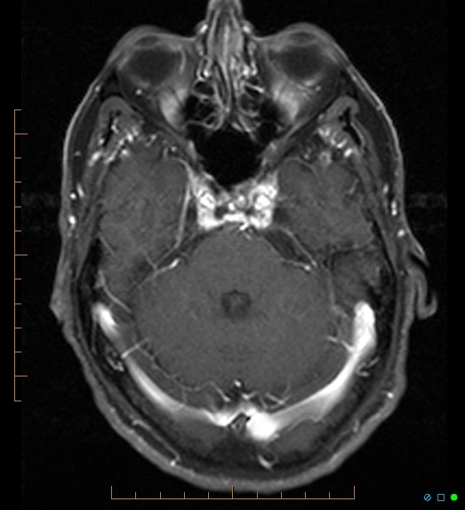 File:Anaplastic astrocytoma (WHO grade III) of the septum pellucidum (Radiopaedia 39365-41633 Axial T1 C+ fat sat 7).jpg