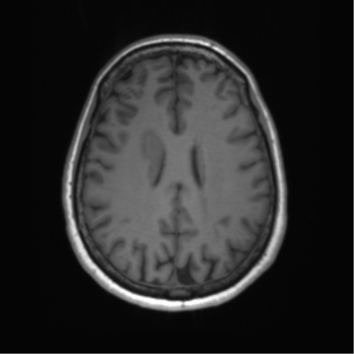 File:Anaplastic astrocytoma - thalamic glioma (Radiopaedia 59709-67115 Axial T1 25).png