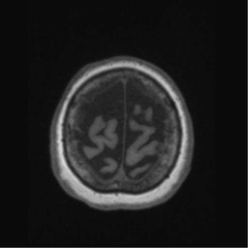 File:Anaplastic astrocytoma IDH wild-type (pseudoprogression) (Radiopaedia 42209-45276 Axial T1 133).png