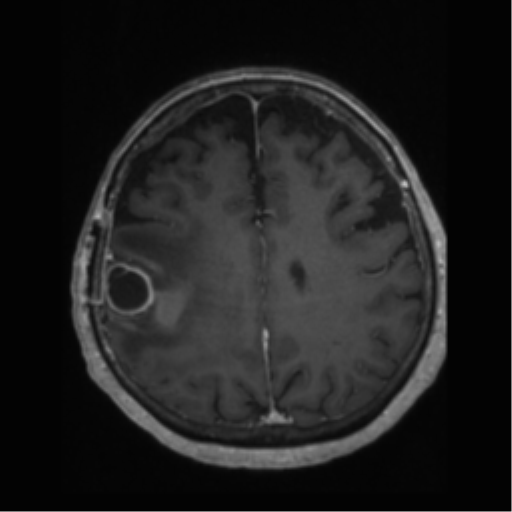 File:Anaplastic astrocytoma IDH wild-type (pseudoprogression) (Radiopaedia 42209-45277 Axial T1 C+ 85).png